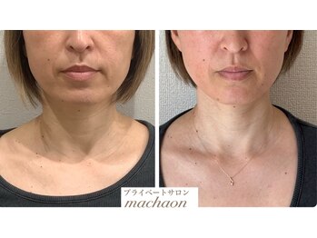 マカオン(machaon)/【小顔リフト】小顔マッサージ
