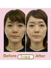 アニュームーン 草津エイスクエア店(aNewMoon)/小顔矯正/ビフォーアフター