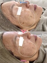 アレイズ(ARAYS)/症例