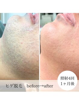 ココスターリー 香椎店(Coco starry)/男性・照射4回☆1ヶ月後