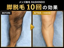 ラシンドウ 横浜鶴見店(RASHINDO)の雰囲気（【脚脱毛の効果】男性の剛毛に特化したハイパワー脱毛で激変）