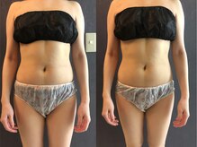 ナラビューティー(NARA BEAUTY)/◇輪郭リフト一回の効果 ◇