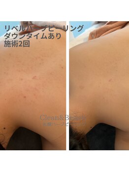 クリーンアンドビューティ 札幌(Clean&Beauty)/長年の背中のお悩みにも♪