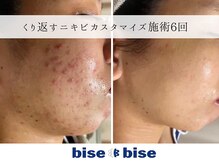 ビズビズ 天王寺店(bisebise)の雰囲気（頑張っても治らないニキビを改善します！）