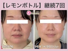 アンリエッタ(Unlieta)/NEW【レモンボトル】