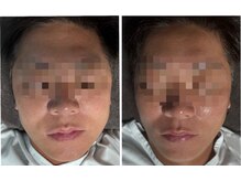 ビー(Be.)/ライトニングプラズマ●1回目