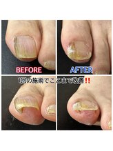 キラキラフット神領 ありが接骨院/巻き爪/フットケア