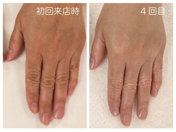 キレイテ 福岡天神店/ゴワつきとくすみ