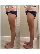 クールスパ(COOL SPA)/40代女性 脚症例