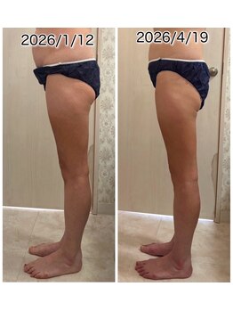 クールスパ(COOL SPA)/40代女性 脚症例