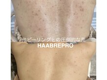 ソアの雰囲気（ボディピーリングも！圧倒的な結果を求める方へ　¥背中ニキビ/）