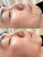 リノ(Lino)/全顔Wax