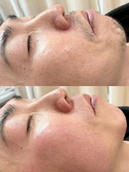 リノ(Lino)/全顔Wax
