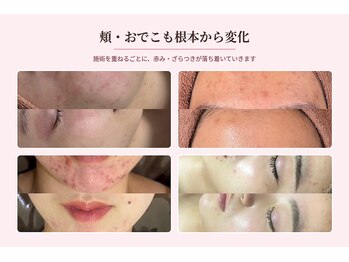 ホワイトアクア 北千住店(WHITE AQUA)の写真/【韓国式ララピール導入★】】話題のララピール×毛穴洗浄で、お肌悩みの改善で理想の美肌GET☆