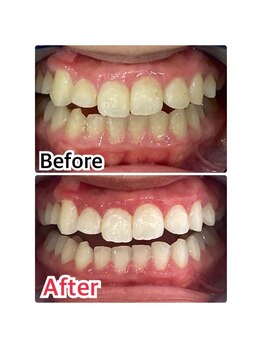 ホワイトニングスタイル 柏店/備品は全て使い捨て！！