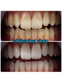 ホワイトニングショップ 福島店(WHITENINGSHOP)/笑顔に自信が持てるように♪