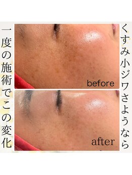 リラキュート(Rela Cute)/ハーブピーリング