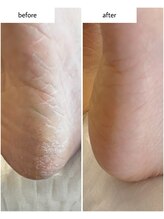 ケアプラス(care plus)/足裏角質ケア