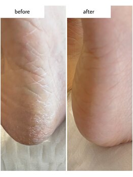 ケアプラス(care plus)/足裏角質ケア