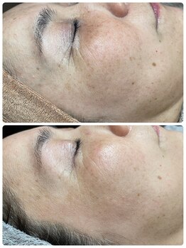 白雲木/シミケア経過途中