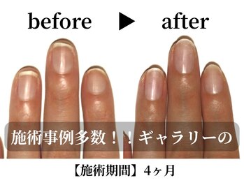 深爪スタンダードコース¥11,000