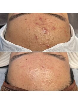 リボンサロン(Ri.bon Salon)/幹細胞ハーブピーリング