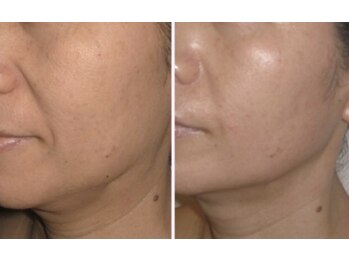 Nビューティー/最新RFサーモシェイプオーパス