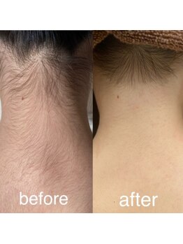 ヘルシースリム 東浦和/人気のLパーツうなじ産毛脱毛！