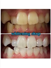 ホワイトニングショップ 鳥取店/ホワイトニングビフォーアフター