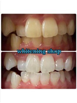 ホワイトニングショップ 鳥取店/ホワイトニングビフォーアフター