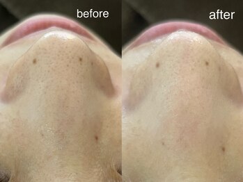 テオリア(TEORIA)/いちご鼻には毛穴洗浄がおすすめ