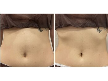 スターティス(STATICE)/ノアグロウ レモンボトル