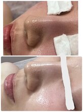 アルカンジュ(Archange)/毛穴洗浄ハイドロコース