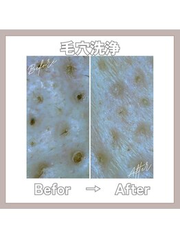 マヴィ 守口店(MavY.)/毛穴の汚れスッキリ