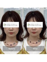 ハリナチュレ 西心斎橋店(HARINATURE)/Before After