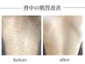 【背中の肌質改善】幹細胞トリートメント¥33000