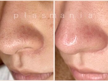 エレグラム(Elegram)/プラズマニア 施術