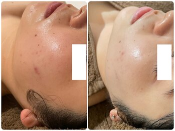 イデアルミー 大宮店(イデアルMe)の写真/【シミ・くすみ】ハーブピーリングケアでハリ・ツヤあふれる透明美肌へ◆開き毛穴・たるみ毛穴にも◎