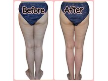 ヨサパーク ハーブチャーム(YOSAPARK herb charm)の雰囲気（50代 水素まみれコース3回目で脚にすき間がしっかりできました♪）