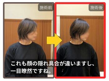 まこと整骨院/寝違いのような首の痛み２