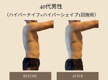 オベリオ(OBERIO)/ハイパーナイフ全身痩身施術