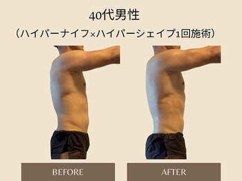 オベリオ(OBERIO)/ハイパーナイフ全身痩身施術