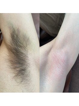 ラウラウ(laulau)/ワキ脱毛