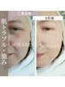 【肌のお悩み解決に】天然ハーブピーリング<フレッシュアップ>¥27500