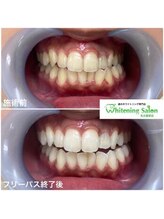 ホワイトニングサロン 名古屋駅店/【ホワイトニング施術例】