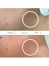 スキン ラボ ケー(Skin lab K)/シミケアのお試し