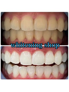 ホワイトニングショップ 加古川店/いつまでも綺麗な歯をキープ