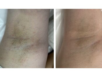 エルマナ(HERMANA)/脱毛/顔脱毛/ワキ/顔脱毛/vio