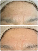 リコ(Lico)/シワケア