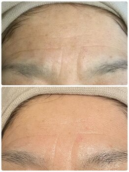 リコ(Lico)/シワケア